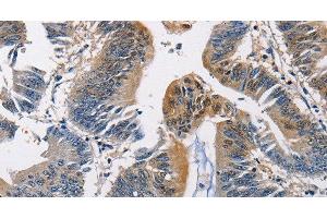 Immunohistochemistry of paraffin-embedded Human colon cancer using PGK1 Polyclonal Antibody at dilution of 1:50 (PGK1 antibody)