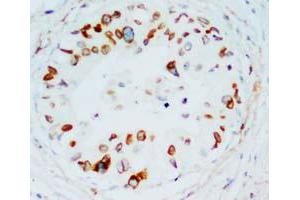 Immunohistochemical staining of LMNB1 on formalin fixed, paraffin embedded human mammary cancer with LMNB1 polyclonal antibody . (Lamin B1 antibody  (C-Term))