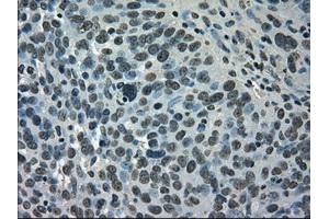 Immunohistochemical staining of paraffin-embedded Adenocarcinoma of breast tissue using anti-SATB1 mouse monoclonal antibody. (SATB1 antibody)