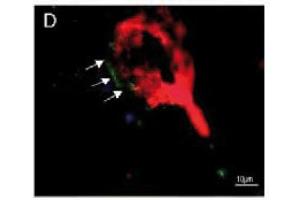 Immunofluorescence image of zonulin staining in cryosection of astrocytoma WHO III. (Zonulin antibody)