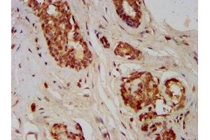 IHC image of ABIN7153745 diluted at 1:400 and staining in paraffin-embedded human breast cancer performed on a Leica BondTM system. (GMDS antibody  (AA 243-346))