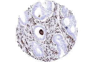 Colon HLA DR negative colorectal adenocarcinoma showing strong HLA DR positivity of capillaries and tumor associated inflammatory cells. (Recombinant HLA-DRA antibody)