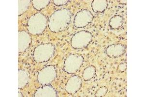 Immunohistochemistry of paraffin-embedded human gastric cancer using ABIN7143774 at dilution of 1:100 (A4GNT antibody  (AA 26-340))