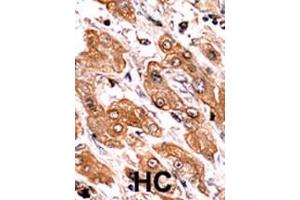 Formalin-fixed and paraffin-embedded human cancer tissue reacted with the primary antibody, which was peroxidase-conjugated to the secondary antibody, followed by AEC staining.