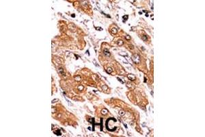 Formalin-fixed and paraffin-embedded human cancer tissue reacted with the primary antibody, which was peroxidase-conjugated to the secondary antibody, followed by AEC staining. (BIK antibody  (pThr33))