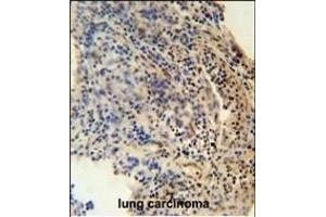 ZN antibody (N-term) (ABIN654489 and ABIN2844223) immunohistochemistry analysis in formalin fixed and paraffin embedded human lung carcinoma followed by peroxidase conjugation of the secondary antibody and DAB staining. (ZNF197 antibody  (N-Term))