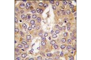 Formalin-fixed and paraffin-embedded human hepatocarcinoma tissue reacted with CK1g2 antibody (C-term), which was peroxidase-conjugated to the secondary antibody, followed by DAB staining. (Casein Kinase 1 gamma 2 antibody  (C-Term))
