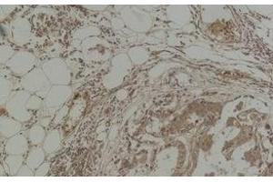 Immunohistochemistry of paraffin-embedded Human breast carcinoma tissue with Pan Methylated Lysine Monoclonal Antibody(Mix). (Methylated Lysine antibody)