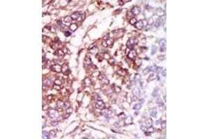 Formalin-fixed and paraffin-embedded human cancer tissue reacted with the primary antibody, which was peroxidase-conjugated to the secondary antibody, followed by DAB staining. (CSNK1G3 antibody  (C-Term))