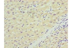 Immunohistochemistry of paraffin-embedded human liver cancer using ABIN7170048 at dilution of 1:100 (NKAIN4 antibody  (AA 83-150))