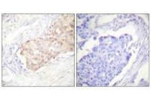 Immunohistochemistry analysis of paraffin-embedded human breast carcinoma tissue using EDD antibody. (UBR5 antibody)