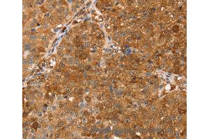 Immunohistochemistry of Human breast cancer using TMSB10 Polyclonal Antibody at dilution of 1:35