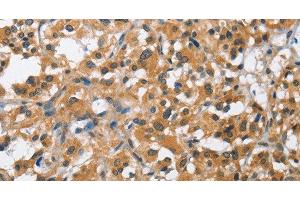 Immunohistochemistry of paraffin-embedded Human thyroid cancer using BCL10 Polyclonal Antibody at dilution of 1:40 (BCL10 antibody)