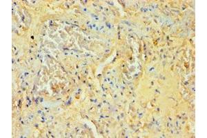 Immunohistochemistry of paraffin-embedded human lung tissue using ABIN7170995 at dilution of 1:100 (SOCS2 antibody  (AA 1-198))