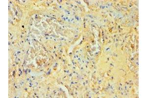 Immunohistochemistry of paraffin-embedded human lung tissue using ABIN7170995 at dilution of 1:100 (SOCS2 antibody  (AA 1-198))