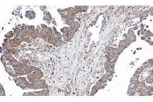 IHC-P Image Immunohistochemical analysis of paraffin-embedded human ovarian cancer, using NT5C2, antibody at 1:100 dilution. (NT5C2 antibody)