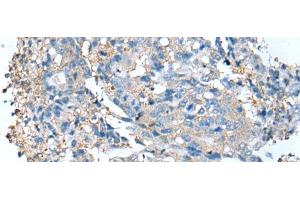 Immunohistochemistry of paraffin-embedded Human colorectal cancer tissue using DCX Polyclonal Antibody at dilution of 1:35(x200) (Doublecortin antibody)