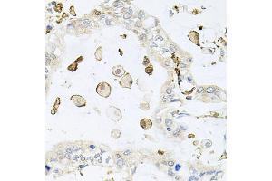 Immunohistochemistry of paraffin-embedded human gastric cancer using AIF1 antibody (ABIN5970719) at dilution of 1/100 (40x lens). (Iba1 antibody)