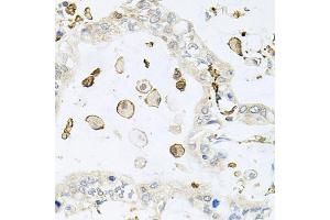 Immunohistochemistry of paraffin-embedded human gastric cancer using AIF1 antibody (ABIN5970719) at dilution of 1/100 (40x lens). (Iba1 antibody)