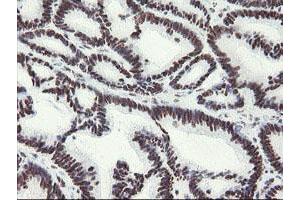 Immunohistochemical staining of paraffin-embedded Adenocarcinoma of Human colon tissue using anti-MLF1 mouse monoclonal antibody.