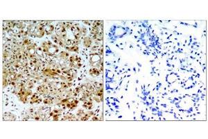 Immunohistochemical analysis of paraffin-embedded human breast carcinoma tissue, using HSP90B (Ab-254) antibody (E021290). (HSP90AB1 antibody)