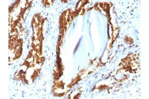IHC testing of human prostate carcinoma with recombinant PSAP antibody (clone rACPP/1338). (Prosaposin antibody)