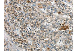 The image on the left is immunohistochemistry of paraffin-embedded Human liver cancer tissue using ABIN7192710(SYCP3 Antibody) at dilution 1/20, on the right is treated with synthetic peptide. (SYCP3 antibody)