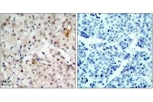 Immunohistochemistry analysis of paraffin-embedded human breast carcinoma tissue, using HER2 (Ab-1221/1222) Antibody. (ErbB2/Her2 antibody  (AA 1191-1240))