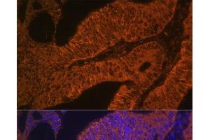 Immunofluorescence analysis of Human colon carcinoma using RAB5B Polyclonal Antibody at dilution of 1:100. (RAB5B antibody)