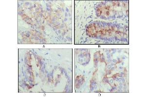Immunohistochemical analysis of paraffin-embedded human lung cancer (A), recturn(B), prostate (C), colon cancer (D) showing cytoplasmic localization using IGFBP2 mouse mAb with DAB staining. (IGFBP2 antibody)