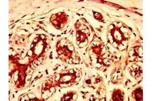 IHC image of ABIN7148050 diluted at 1:300 and staining in paraffin-embedded human breast cancer performed on a Leica BondTM system. (STAG3 antibody  (AA 1056-1212))