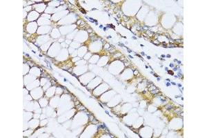 Immunohistochemistry of paraffin-embedded Human colon carcinoma using ALOX12 Polyclonal Antibody at dilution of 1:100 (40x lens). (ALOX12 antibody)