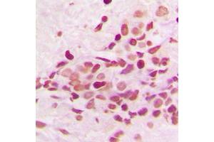 Immunohistochemical analysis of PKNOX2 staining in human breast cancer formalin fixed paraffin embedded tissue section. (PKNOX2 antibody  (C-Term))