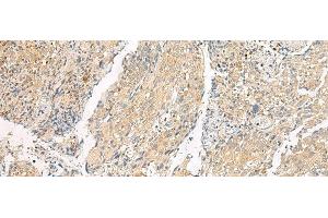 Immunohistochemistry of paraffin-embedded Human cervical cancer tissue using HEBP1 Polyclonal Antibody at dilution of 1:60(x200)