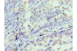 Immunohistochemistry of paraffin-embedded human lung cancer using ABIN7156833 at dilution of 1:100 (IL18RAP antibody  (AA 390-599))