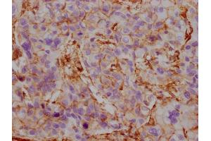 IHC image of ABIN7180354 diluted at 1:100 and staining in paraffin-embedded human liver cancer performed on a Leica BondTM system. (ACTB/POTEKP/ACTG1 antibody)