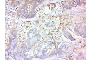 Formalin-fixed and paraffin embedded human lung carcinoma labeled with Anti-MMP-2 Polyclonal Antibody, Unconjugated  at 1:200 followed by conjugation to the secondary antibody and DAB staining.
