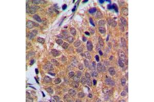 Immunohistochemical analysis of p18 INK4c staining in human breast cancer formalin fixed paraffin embedded tissue section. (CDKN2C antibody  (C-Term))