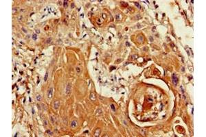 Immunohistochemistry of paraffin-embedded human cervical cancer using ABIN7169412 at dilution of 1:100 (SETD5 antibody  (AA 519-700))