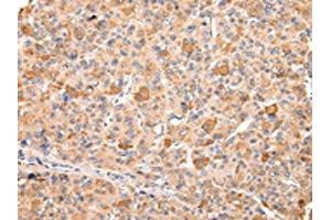 The image on the left is immunohistochemistry of paraffin-embedded Human liver cancer tissue using ABIN7192170(RERE Antibody) at dilution 1/20, on the right is treated with synthetic peptide. (RERE antibody)
