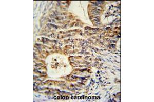 KLHL24 Antibody immunohistochemistry analysis in formalin fixed and paraffin embedded human colon carcinoma followed by peroxidase conjugation of the secondary antibody and DAB staining.