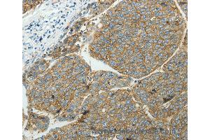Immunohistochemistry of Human ovarian cancer using SLC16A1 Polyclonal Antibody at dilution of 1:50 (SLC16A1 antibody)