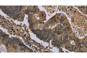Immunohistochemistry of paraffin-embedded Human colon cancer using GSTO1 Polyclonal Antibody at dilution of 1:60 (GSTO1 antibody)
