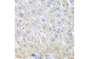 Immunohistochemistry of paraffin-embedded human liver cancer using PTGS1 antibody. (PTGS1 antibody)