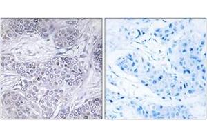 Immunohistochemistry analysis of paraffin-embedded human breast carcinoma tissue, using CEBPG Antibody.