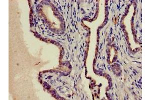 Immunohistochemistry of paraffin-embedded human prostate cancer using ABIN7169141 at dilution of 1:100 (PIM1 antibody  (AA 25-86))