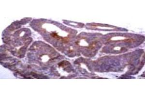 Immunohistochemical staining of TIMP1 on human colon carcinoma tissue with TIMP1 monoclonal antibody, clone 2A5 .