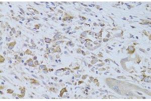 Immunohistochemistry of paraffin-embedded Human breast cancer using IGF2 Polyclonal Antibody at dilution of 1:100 (40x lens). (IGF2 antibody)