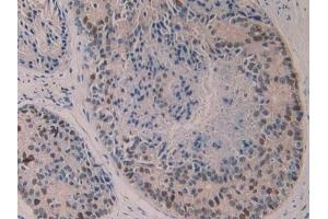 Detection of 5-LO in Human Prostate cancer Tissue using Polyclonal Antibody to 5-Lipoxygenase (5-LO) (ALOX5 antibody  (AA 461-671))