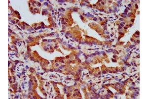 IHC image of ABIN7161158 diluted at 1:500 and staining in paraffin-embedded human lung cancer performed on a Leica BondTM system. (NPHP4 antibody  (AA 397-543))